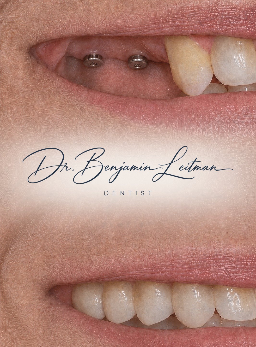 Implant abutments in the upper right quadrant prior to delivery of a three-unit bridge
