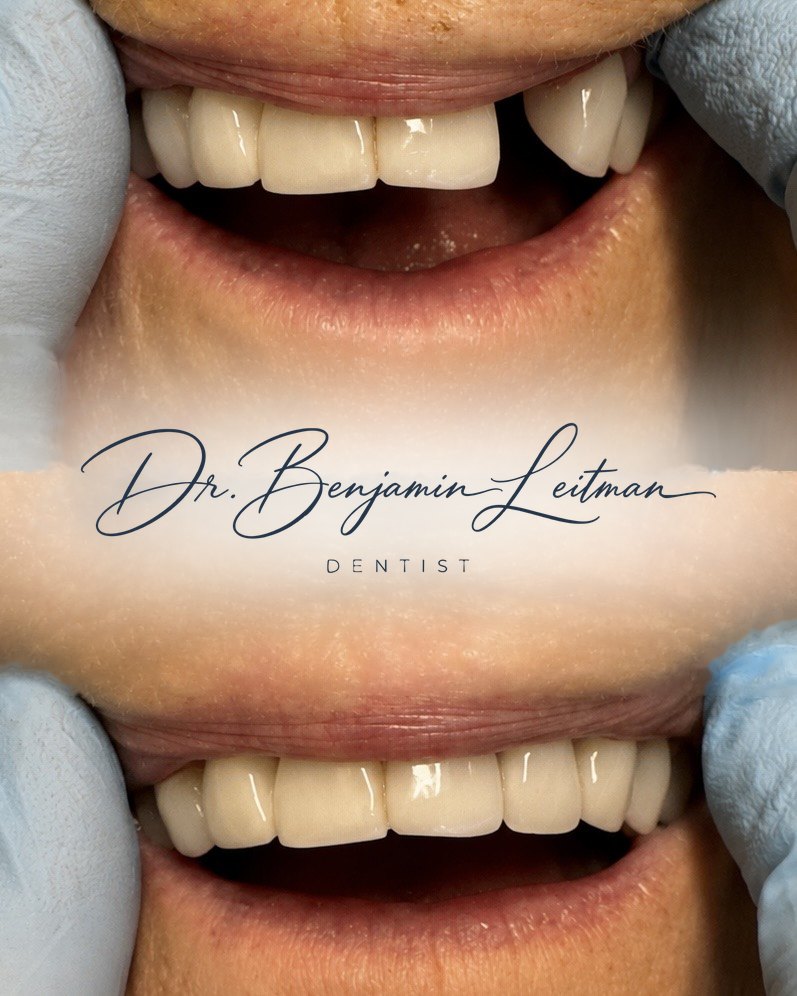 Missing maxillary lateral incisor before and after interim replacement