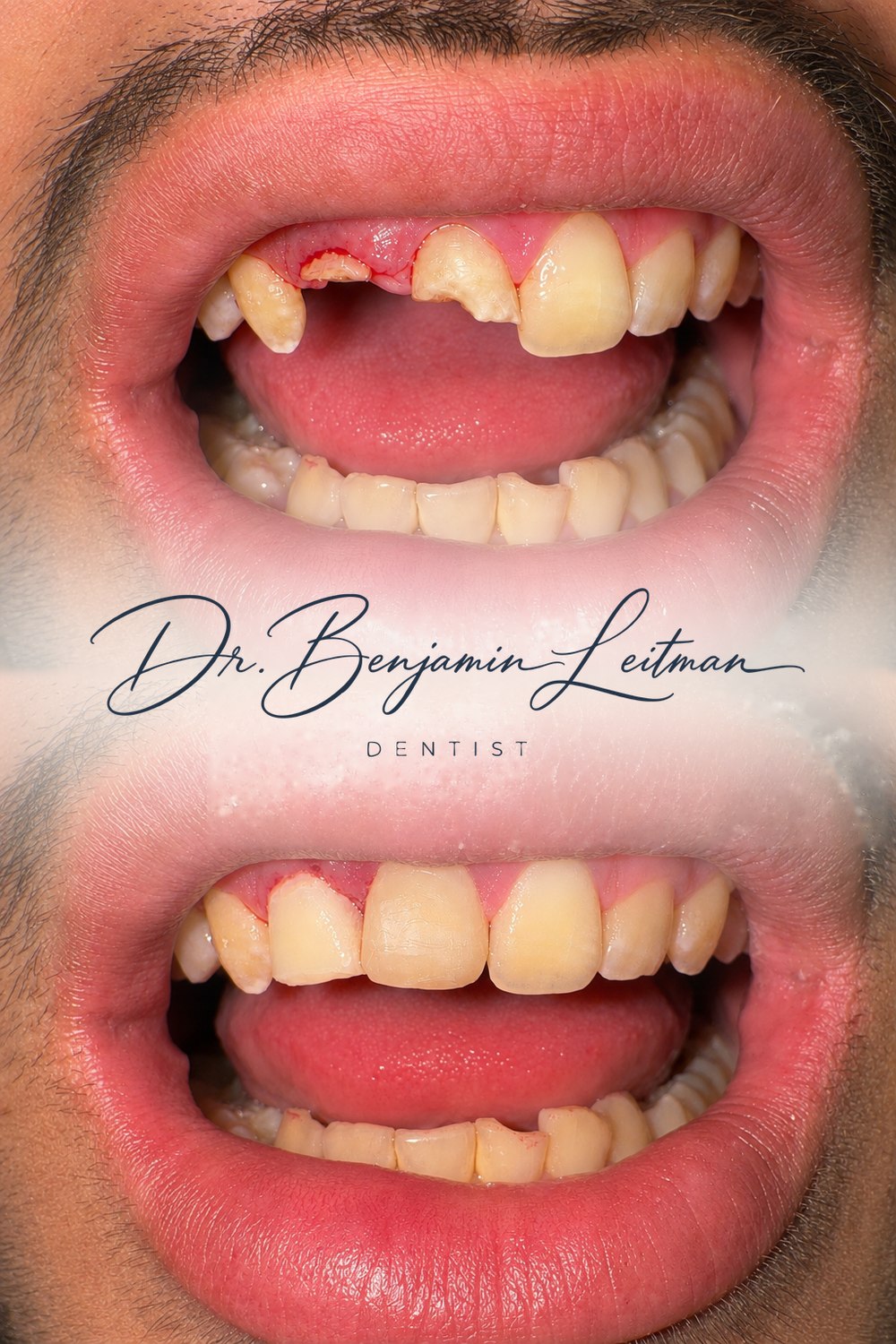 Fractured maxillary central and lateral incisor before and after restoration